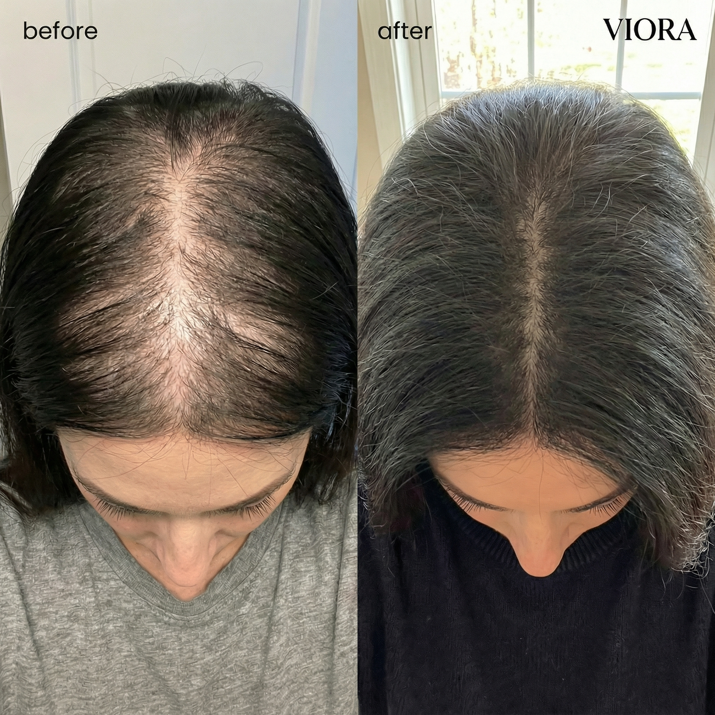 Hair Density Micro-Infusion System - Save Up To 78% Today + 4 FREE Gifts