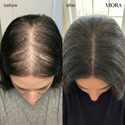 Hair Density Micro-Infusion System - Save Up To 78% Today + 4 FREE Gifts