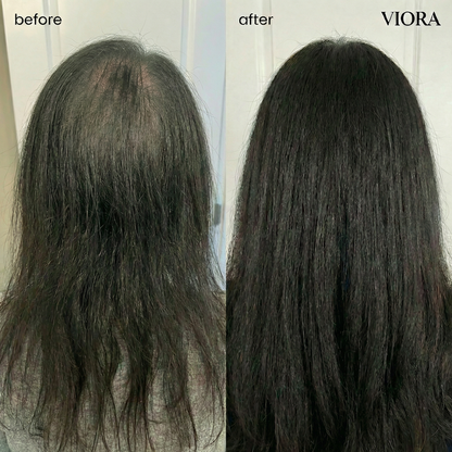 Hair Density Micro-Infusion System - Save Up To 78% Today + 4 FREE Gifts