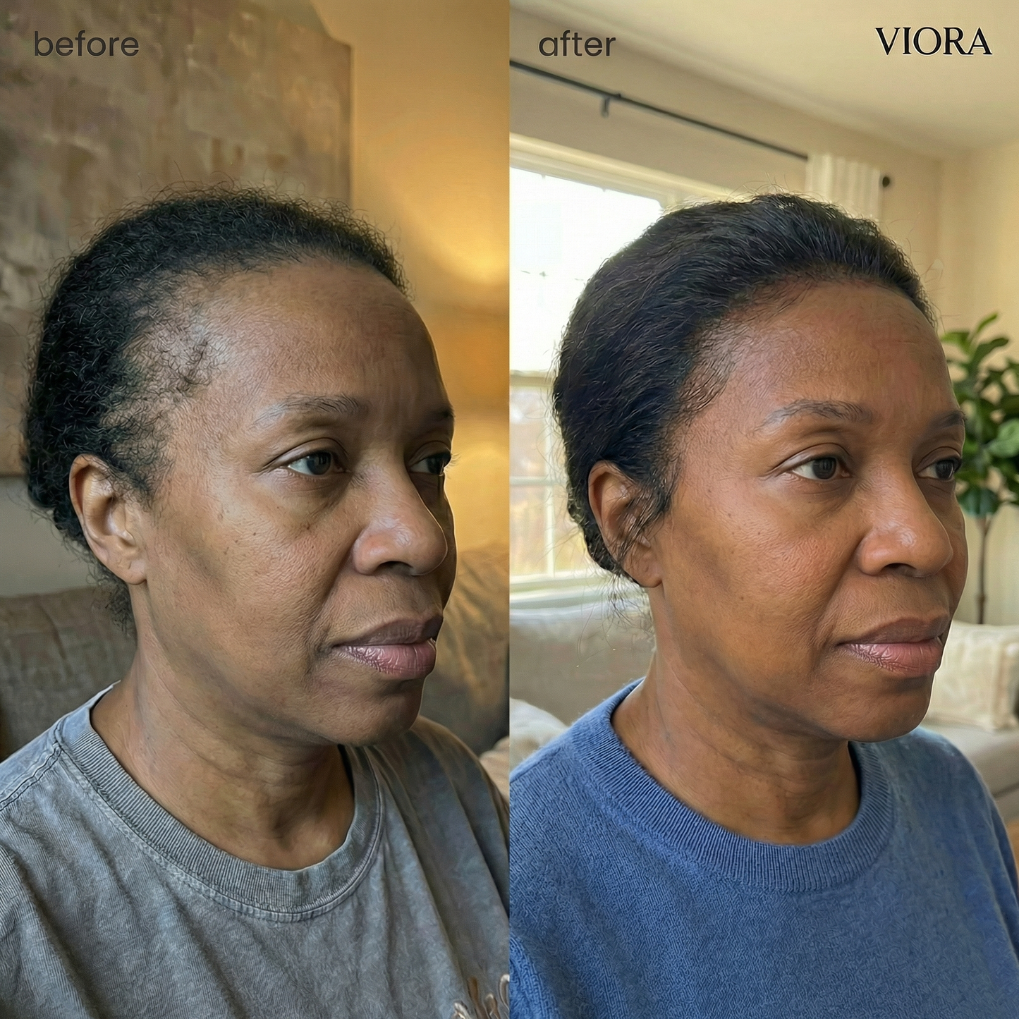 Hair Density Micro-Infusion System - Save Up To 78% Today + 4 FREE Gifts