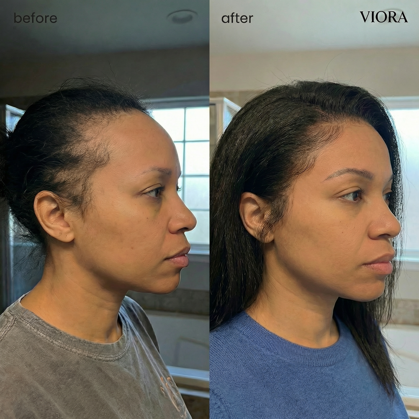 Hair Density Micro-Infusion System - Save Up To 78% Today + 4 FREE Gifts