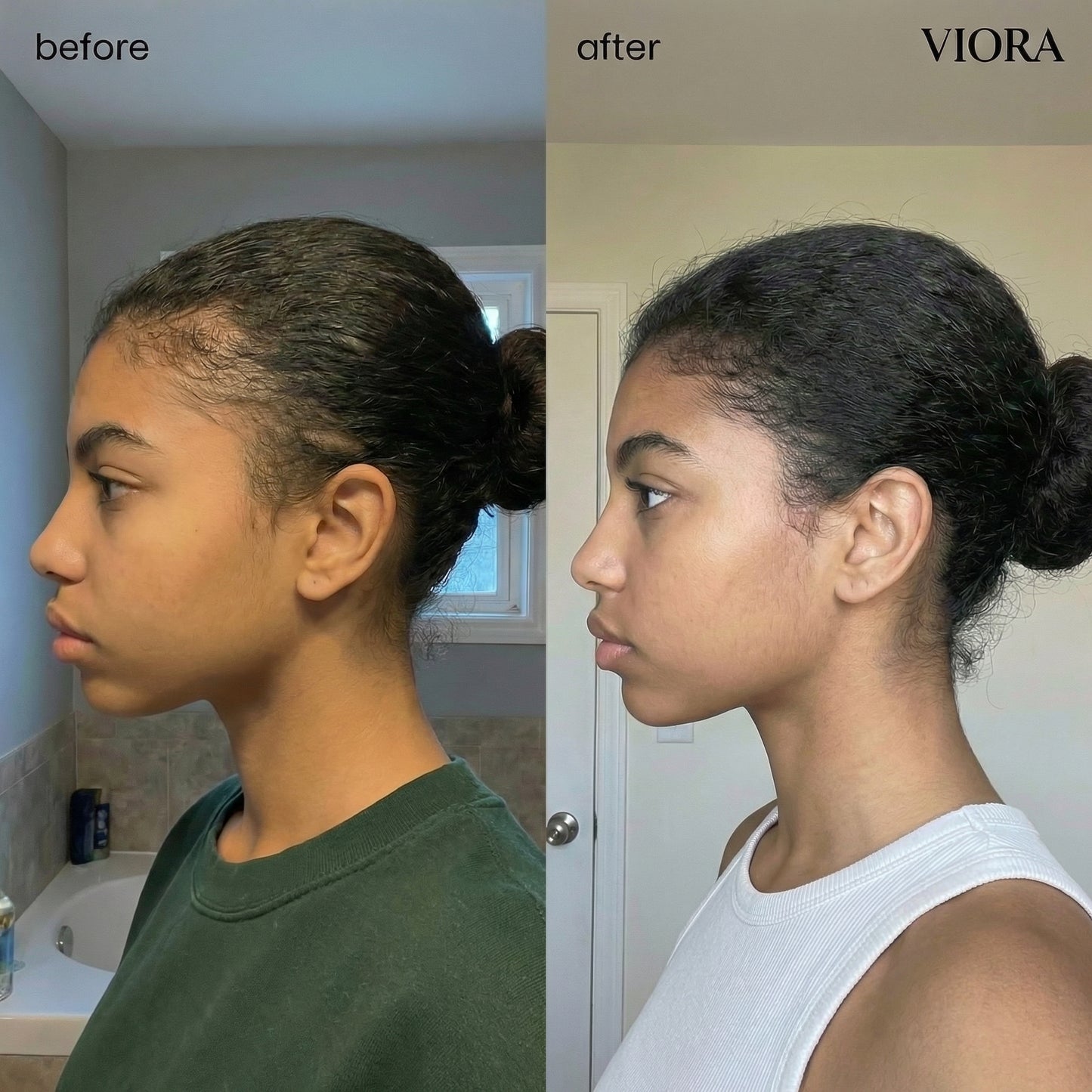 Hair Density Micro-Infusion System - Save Up To 78% Today + 4 FREE Gifts