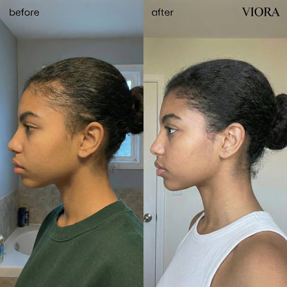 Hair Density Micro-Infusion System - Save Up To 78% Today + 4 FREE Gifts