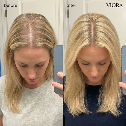 Hair Density Micro-Infusion System - Save Up To 78% Today + 4 FREE Gifts